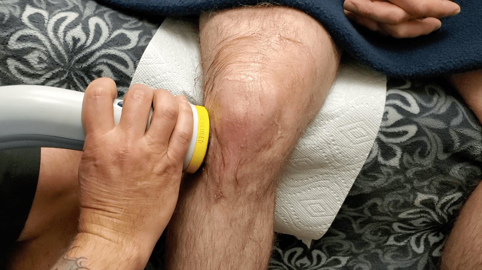 Can SoftWave Therapy Help Treat Varicose Veins? - SoftWave